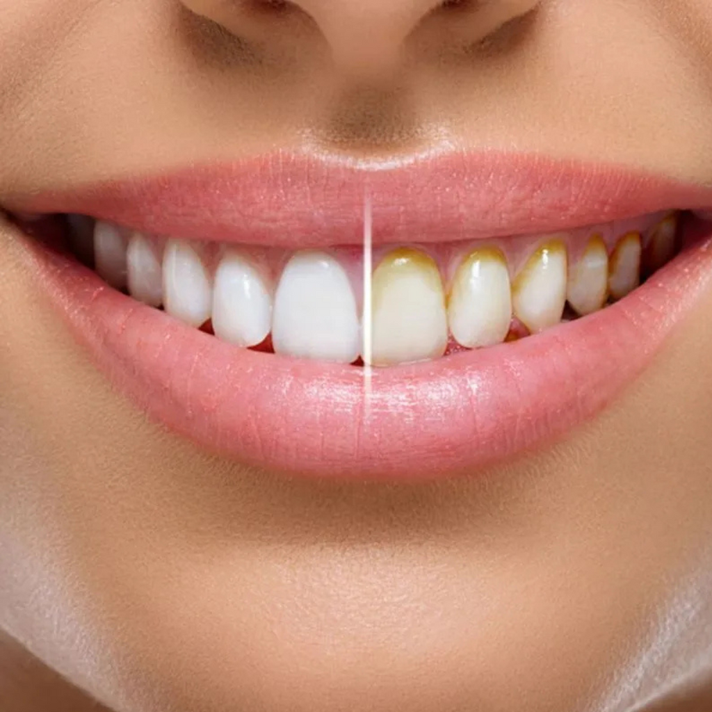 Miracle Smile - Irrigador dental doble