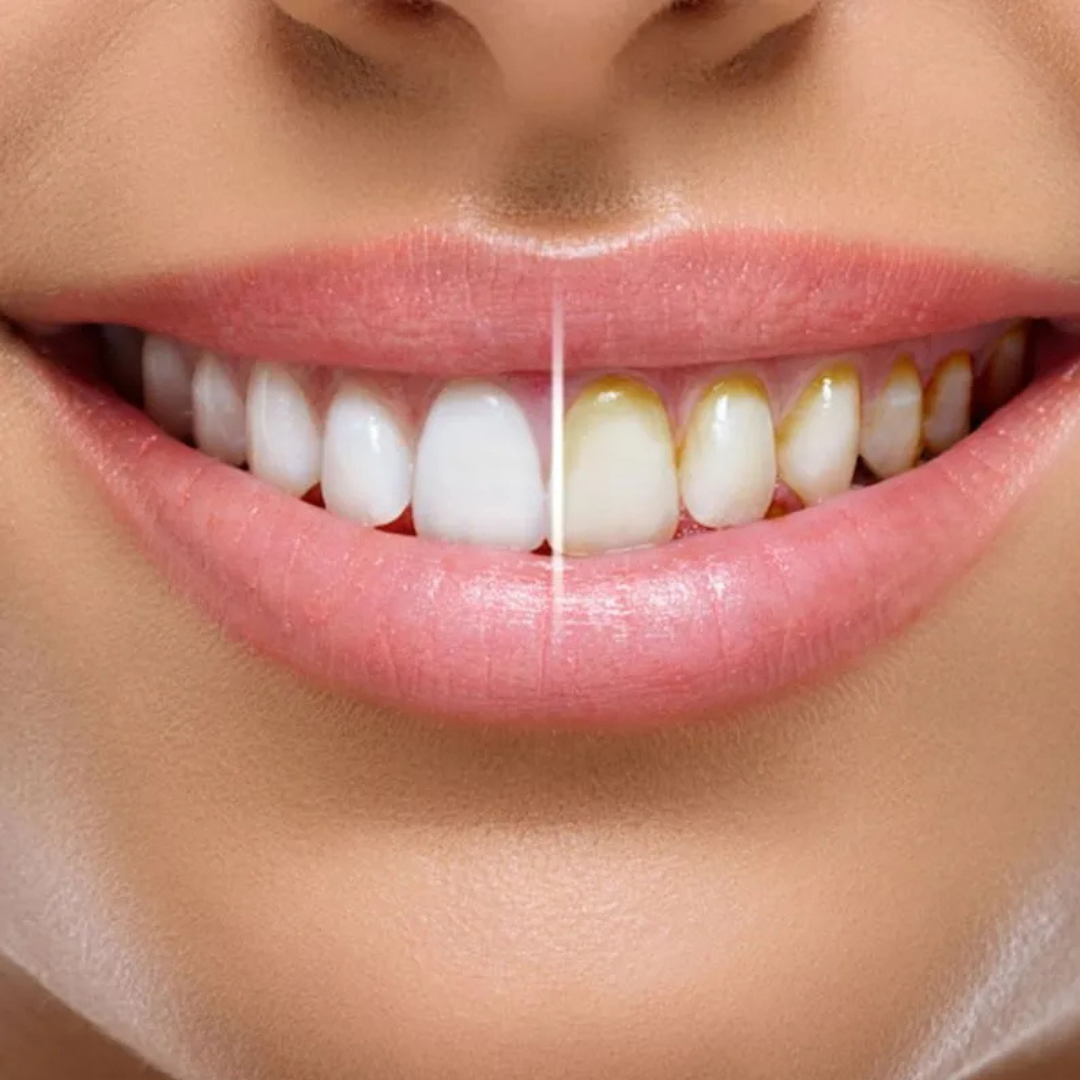 Miracle Smile - Irrigador dental doble